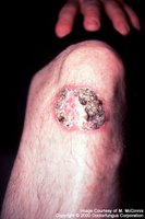Blastomycosis lesion on the knee