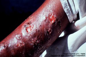 Sporotrichosis lesion on the arm