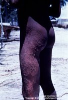 Trichophyton infection with circular lesions