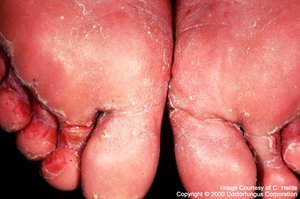 Tinea pedis (athlete's foot)
