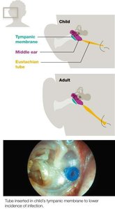 Diagram of child and adult ear anatomy and tympanostomy tube