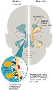 Diagram comparing healthy sinuses and sinusitis