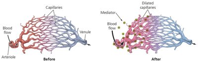 Diagram showing vasodilation during inflammation