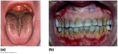 Side effects resulting from toxicity of antimicrobial agents