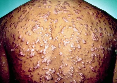 Secondary syphilis rash on the back