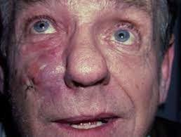 Stages of syphilis: primary chancre, secondary rash, tertiary gumma