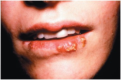 Herpes simplex lesions on the lips