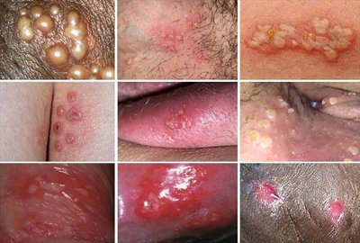 Various presentations of genital herpes lesions