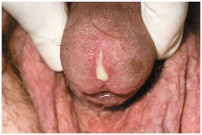 Clinical image of penile discharge in gonorrhea