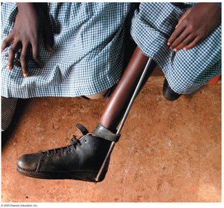 Child with polio leg brace