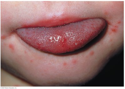 Hand-foot-and-mouth disease lesions