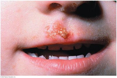 Impetigo lesion on a child's face