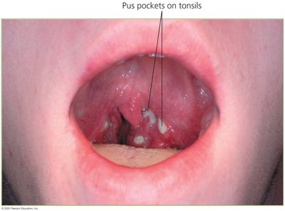 Pus pockets on tonsils in streptococcal pharyngitis