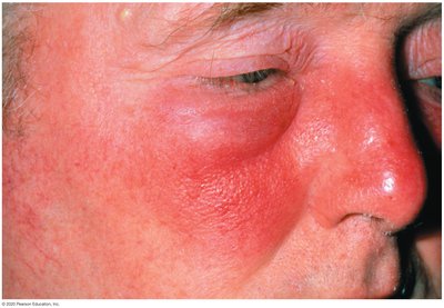 Erysipelas (facial skin infection)
