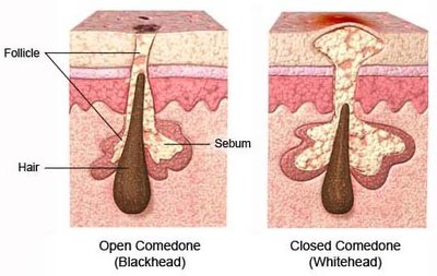 Diagram of open and closed comedones in acne