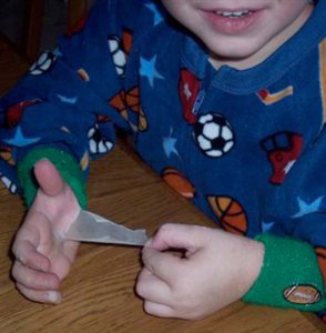 Child with peeling skin, scalded skin syndrome
