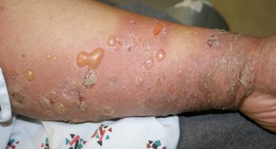 Arm with blisters, scalded skin syndrome