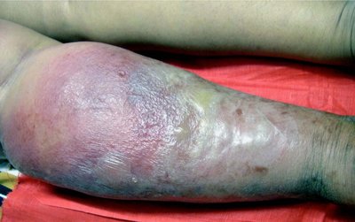 Arm with severe swelling and necrosis, necrotizing fasciitis