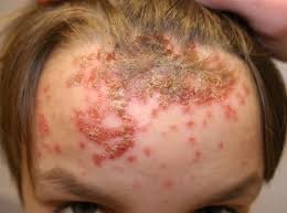 Impetigo on forehead