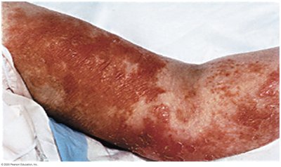 Arm with crusted lesions, impetigo