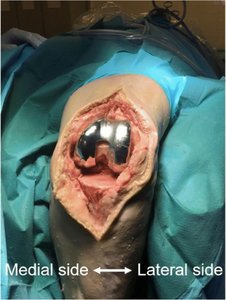 Innovative catheter design for biofilm removal