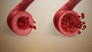 Blood vessel showing diapedesis of immune cells