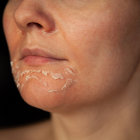 Peeling skin showing desquamation process