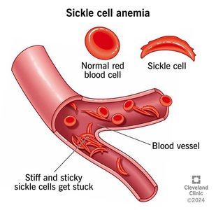 Sickle cell anemia and its evolutionary relationship with malaria