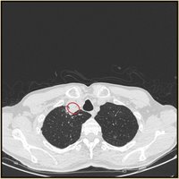 CT scan showing fungal abscess in human