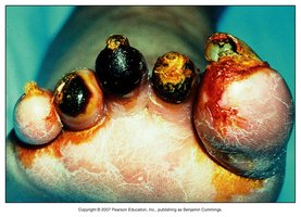 Gangrene affecting multiple toes