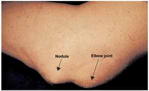 Rheumatic fever: nodule near elbow joint