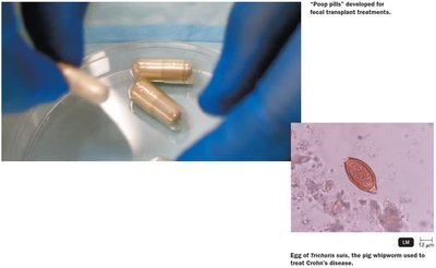 Fecal transplant capsules and whipworm egg for Crohn's disease treatment