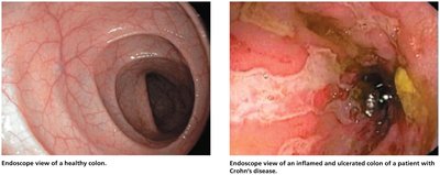 Endoscopic views of healthy and inflamed colon in Crohn's disease