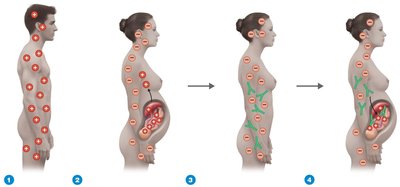 Hemolytic disease of the newborn due to Rh incompatibility