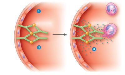 Immune complex-mediated hypersensitivity: deposition in blood vessel wall