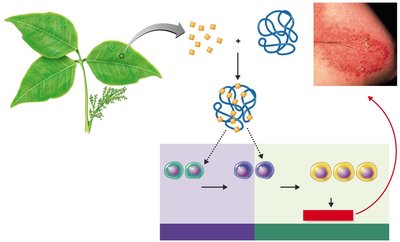 Development of allergic contact dermatitis to poison ivy
