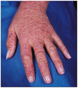 Allergic contact dermatitis on the skin