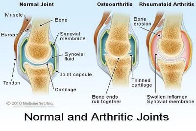 Normal and arthritic joints: osteoarthritis and rheumatoid arthritis