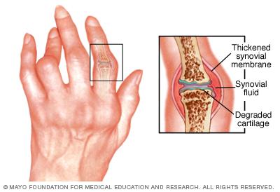 Hand with rheumatoid arthritis showing thickened synovial membrane