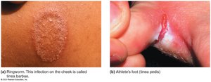 Tinea infections (ringworm, athlete's foot)