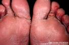 Athlete's foot