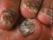 Tinea unguium (nail infection)