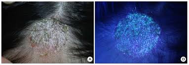 Woods lamp diagnosis of tinea