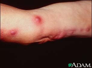 Sporotrichosis lesions