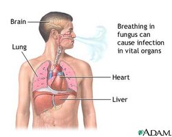 Systemic fungal infection diagram