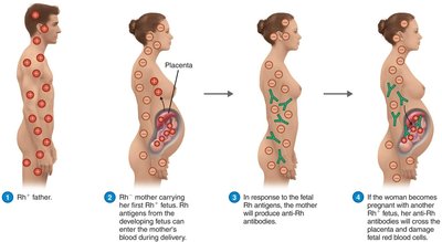 Hemolytic disease of the newborn