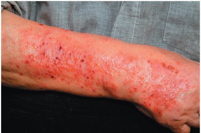 Allergic contact dermatitis