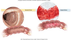 Normal GI Tract vs Shigella Effects