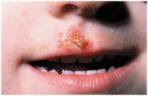 Impetigo lesion on the upper lip of a child