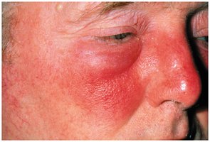 Erysipelas on the face